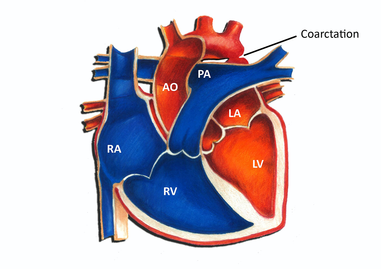 Coarctation of the Aorta - Surgical Repair - Pediatric Heart Specialists