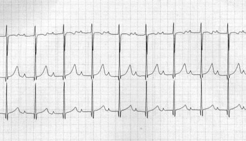 First Degree AV Block