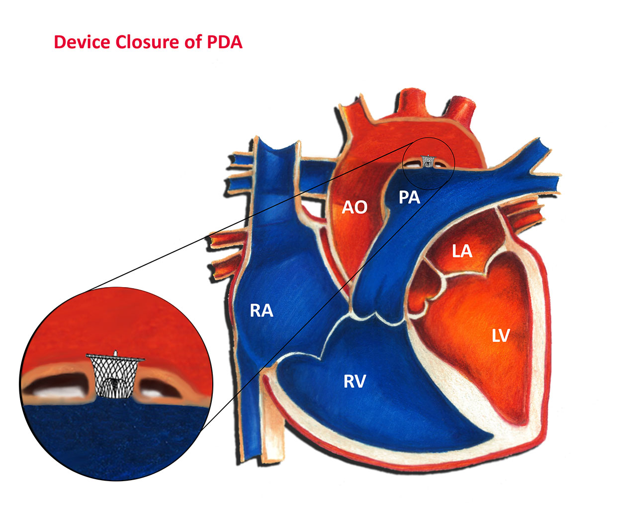 Percutaneous Patent Ductus Arteriosus Pda Closure In Very Preterm | My ...