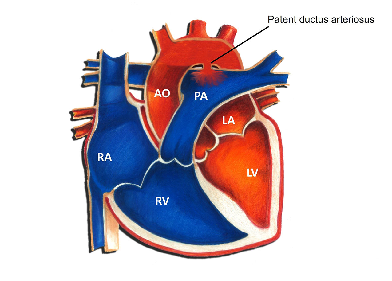 Ductus Arteriosus