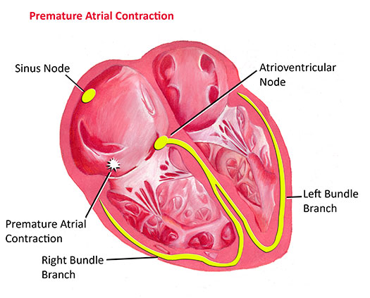 Premature Atrial Contractions