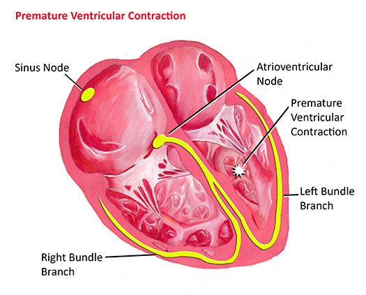 Premature Ventricular Contractions