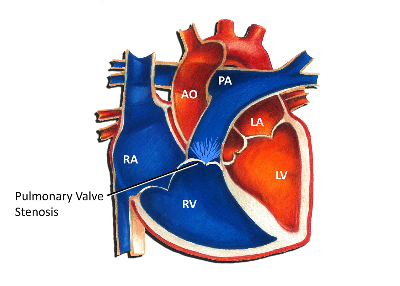 Pulmonary Valve Location