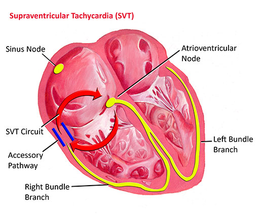 Supraventricular Tachycardia - Pediatric Heart Specialists